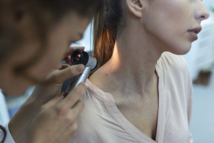melanoma
