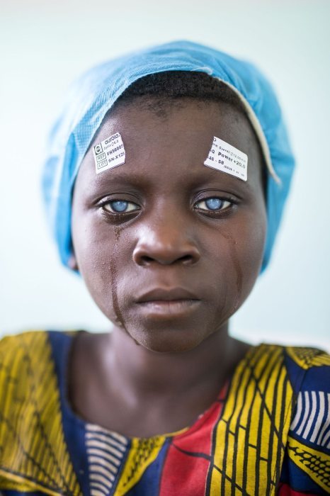 The face of a Congolese girl before cataract surgery
